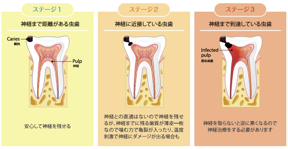 ステージ１：神経まで距離がある虫歯 ステージ2：神経に近接している虫歯 ステージ3：神経まで到達している虫歯