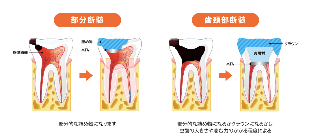 保存 療法 と は