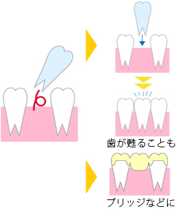 抜けた状態【恵比寿の歯科・歯医者　さとうデンタルクリニック】