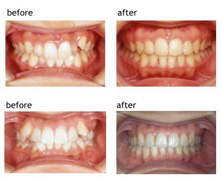 矯正治療のBefore/After