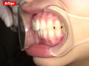 審美歯科症例after03