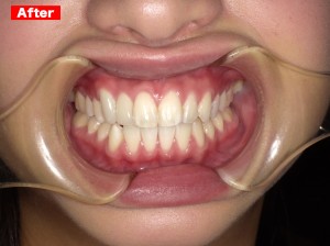 審美歯科症例after02