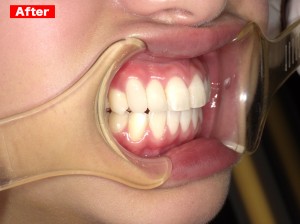 審美歯科症例after04