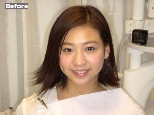 審美歯科症例before01