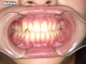 審美歯科症例before02