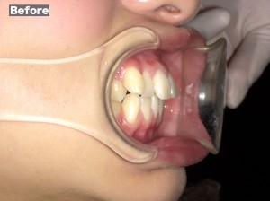 審美歯科症例before04