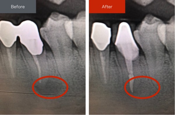 精密根管治療のBefore/After【恵比寿の歯科・歯医者　さとうデンタルクリニック】