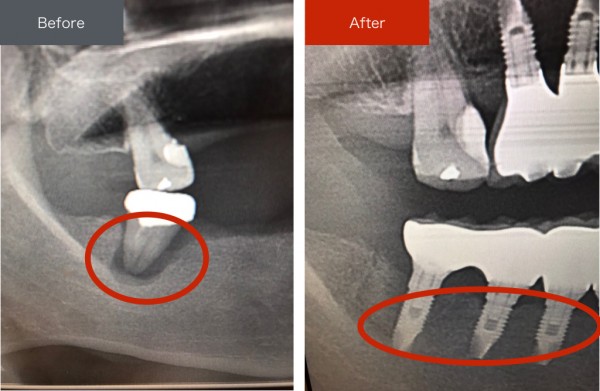 インプラント症例画像　【恵比寿の歯科・歯医者　さとうデンタルクリニック】