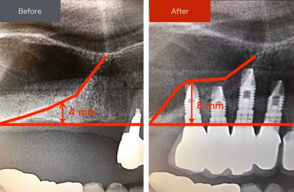 インプラント症例画像　【恵比寿の歯科・歯医者　さとうデンタルクリニック】