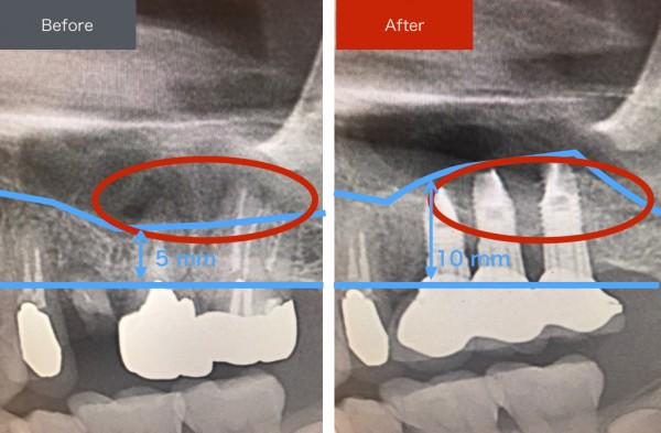 インプラント症例画像　【恵比寿の歯科・歯医者　さとうデンタルクリニック】