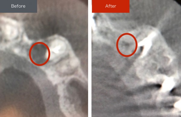 精密根管治療症例画像　【恵比寿の歯科・歯医者　さとうデンタルクリニック】