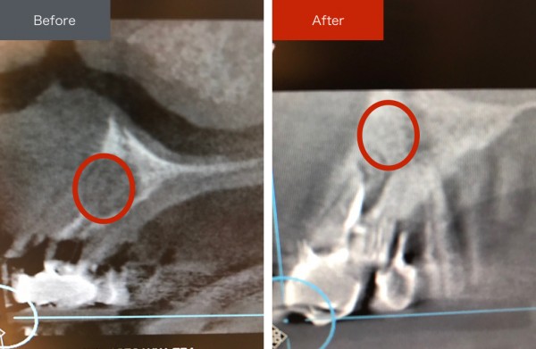 精密根管治療症例画像　【恵比寿の歯科・歯医者　さとうデンタルクリニック】