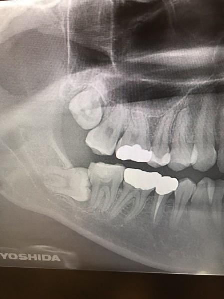 親知らず抜歯症例画像　【恵比寿の歯科・歯医者　さとうデンタルクリニック】