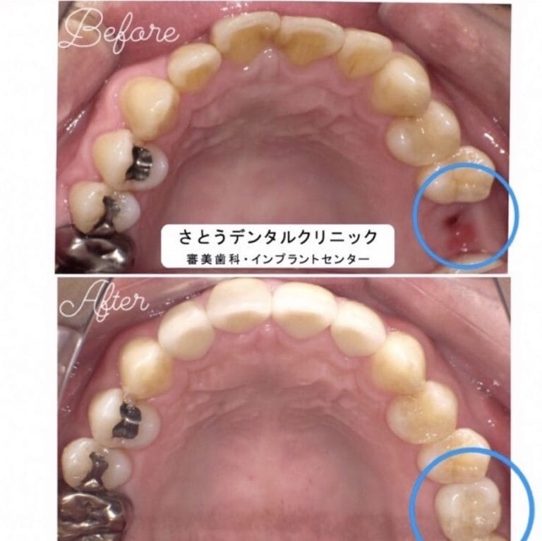症例写真 セラミック矯正 / インプラント