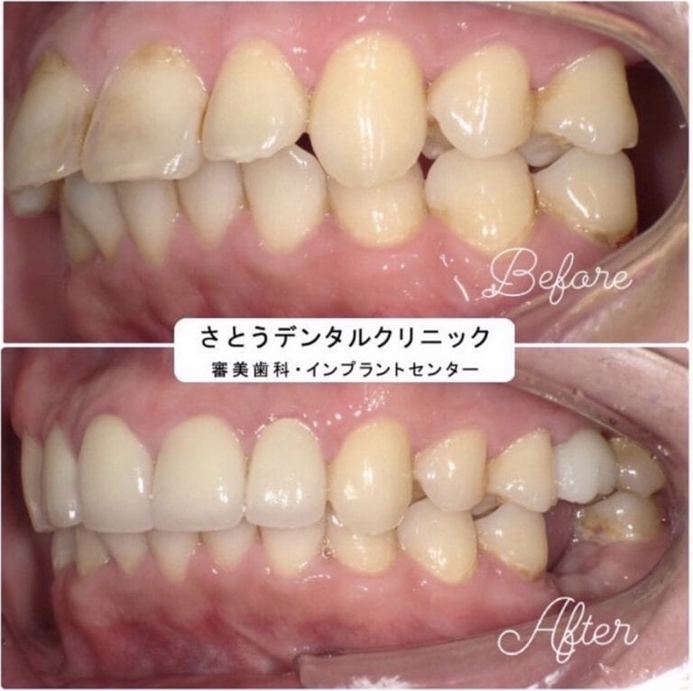 症例写真 セラミック矯正 / インプラント