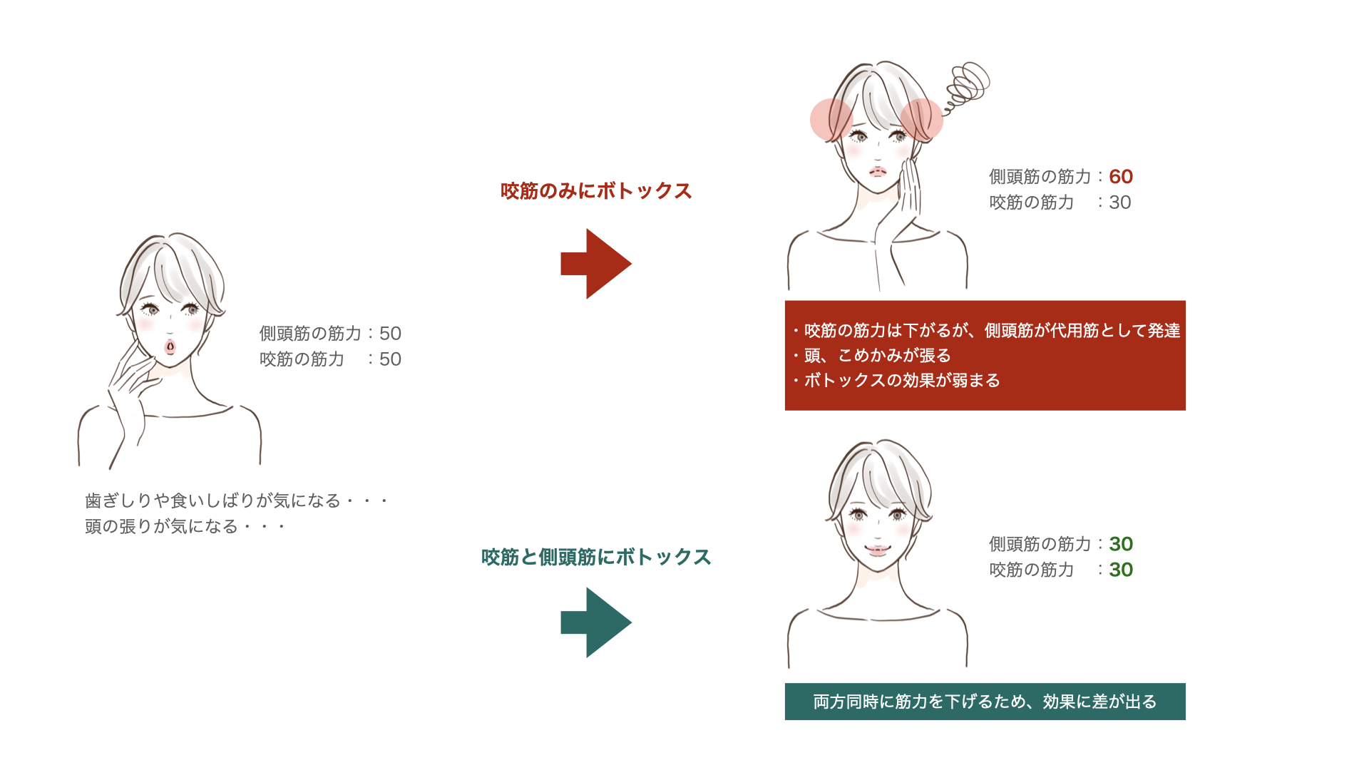 ボトックス治療の咬筋と側頭筋に対する効果について