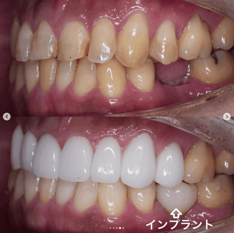 症例写真 セラミック矯正 / インプラント / ホワイトニング
