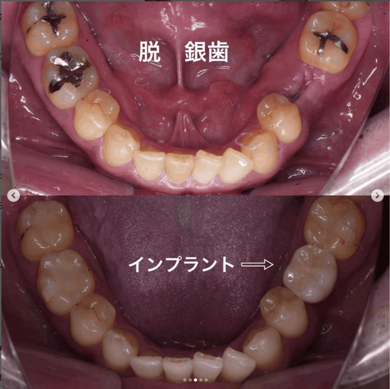 症例写真 セラミック矯正 / インプラント / ホワイトニング
